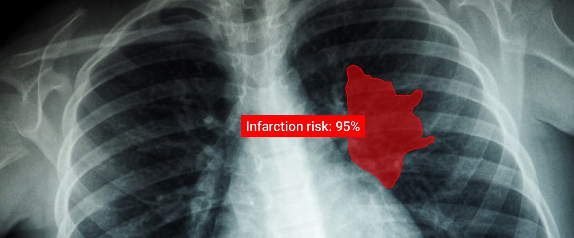 An example of a labeled medical imaging, where the heart is labeled using polygons