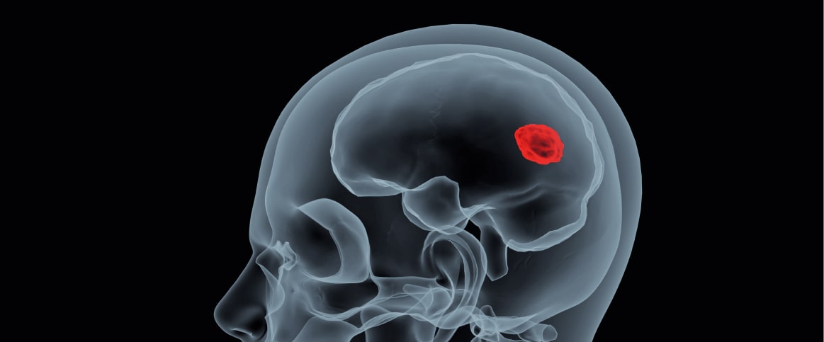 An example of 3d volume annotation for CT Scan Lesion Annotation