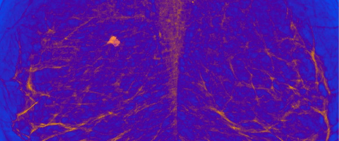 An example of heatmap annotation for mammogram cancer screening