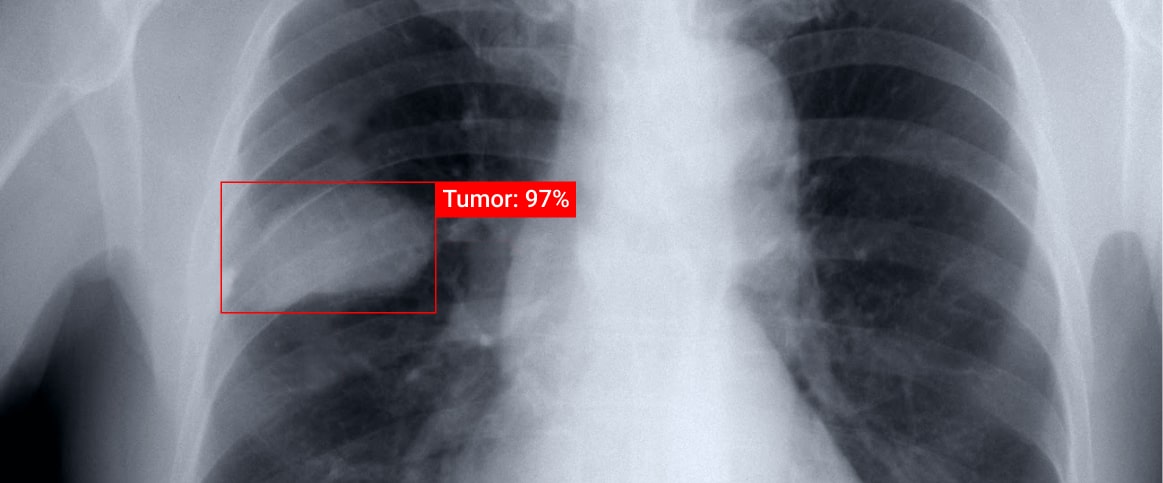 An example of bounding box annotation for x-ray tumor detection