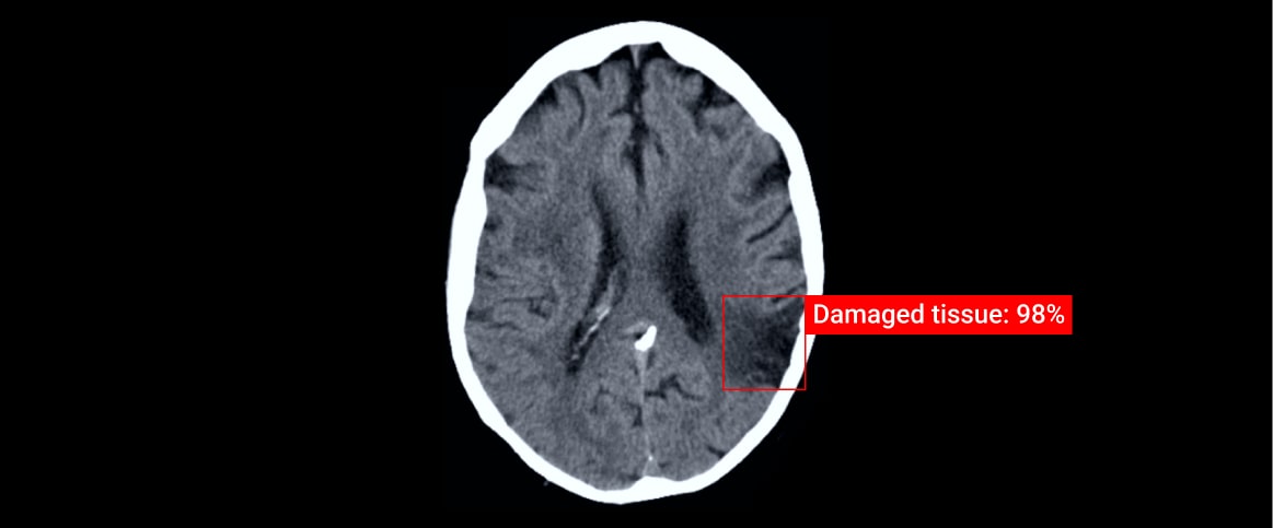 An example of bounding box annotation for CT Scan Lesion Annotation