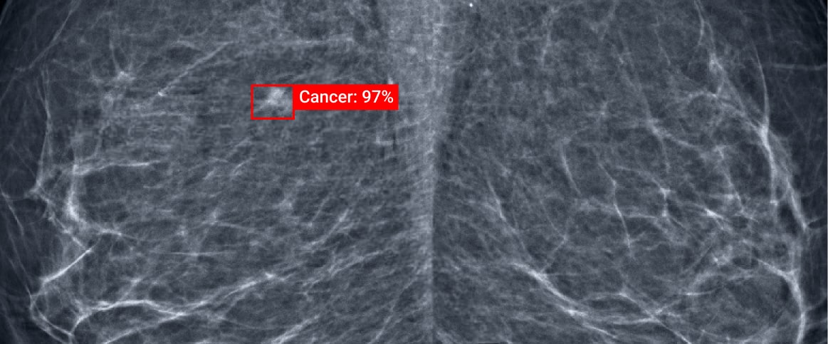 An example of bounding box annotation for mammogram cancer screening