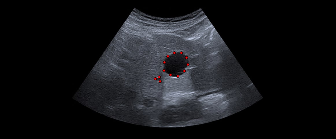 An example of point annotation for ultrasound abnormality detection