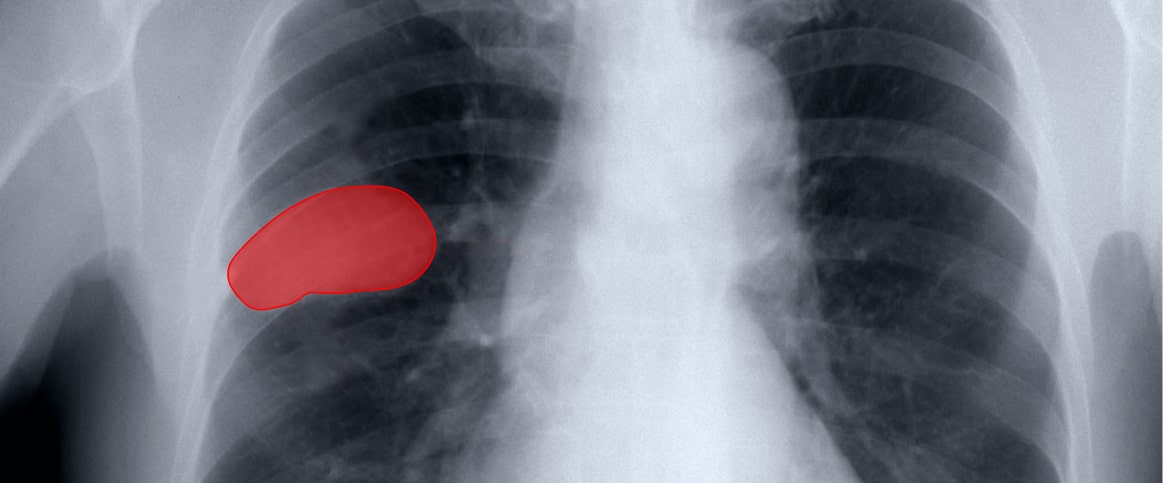 An example of polygon annotation for x-ray tumor detection