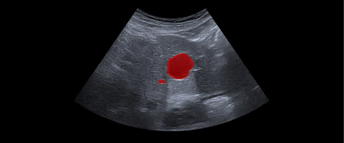 An example of polygon annotation for ultrasound abnormality detection