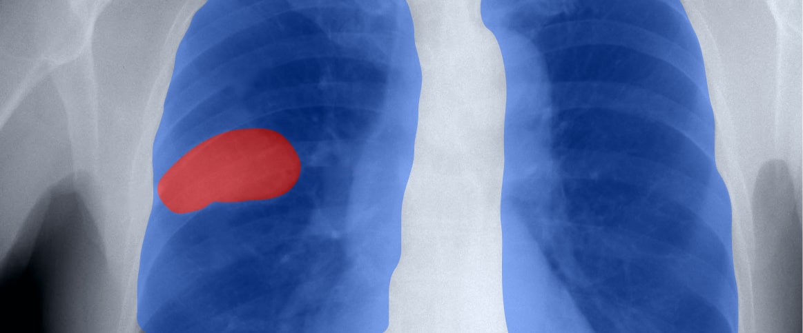 An example of semantic segmentation annotation for x-ray tumor detection