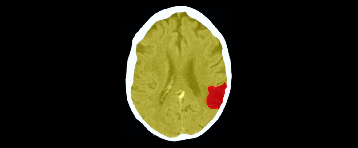 An example of semantic segmentation for CT Scan Lesion Annotation