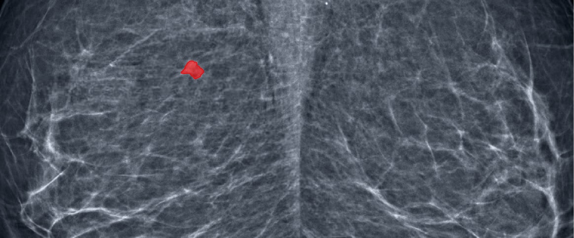 An example of semantic segmentation for mammogram cancer screening