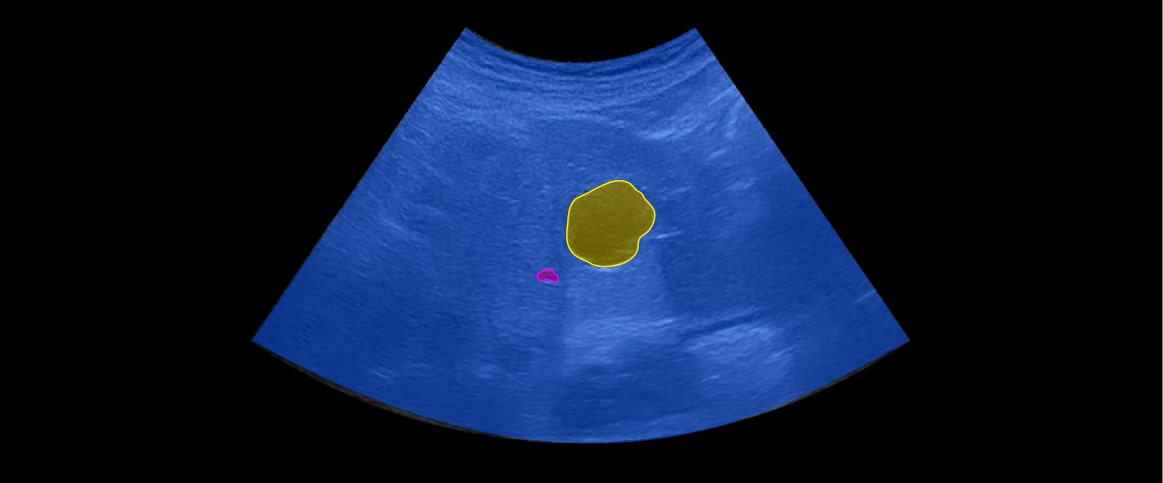 An example of semantic segmentation for ultrasound abnormality detection